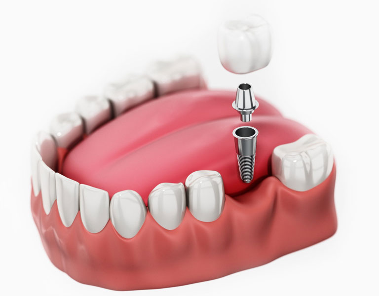 Dental Implants