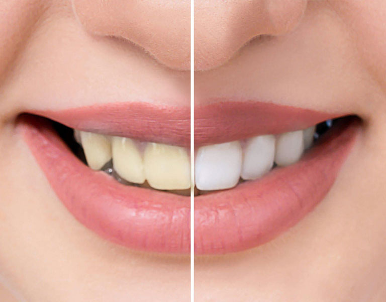 Professional Teeth Whitening