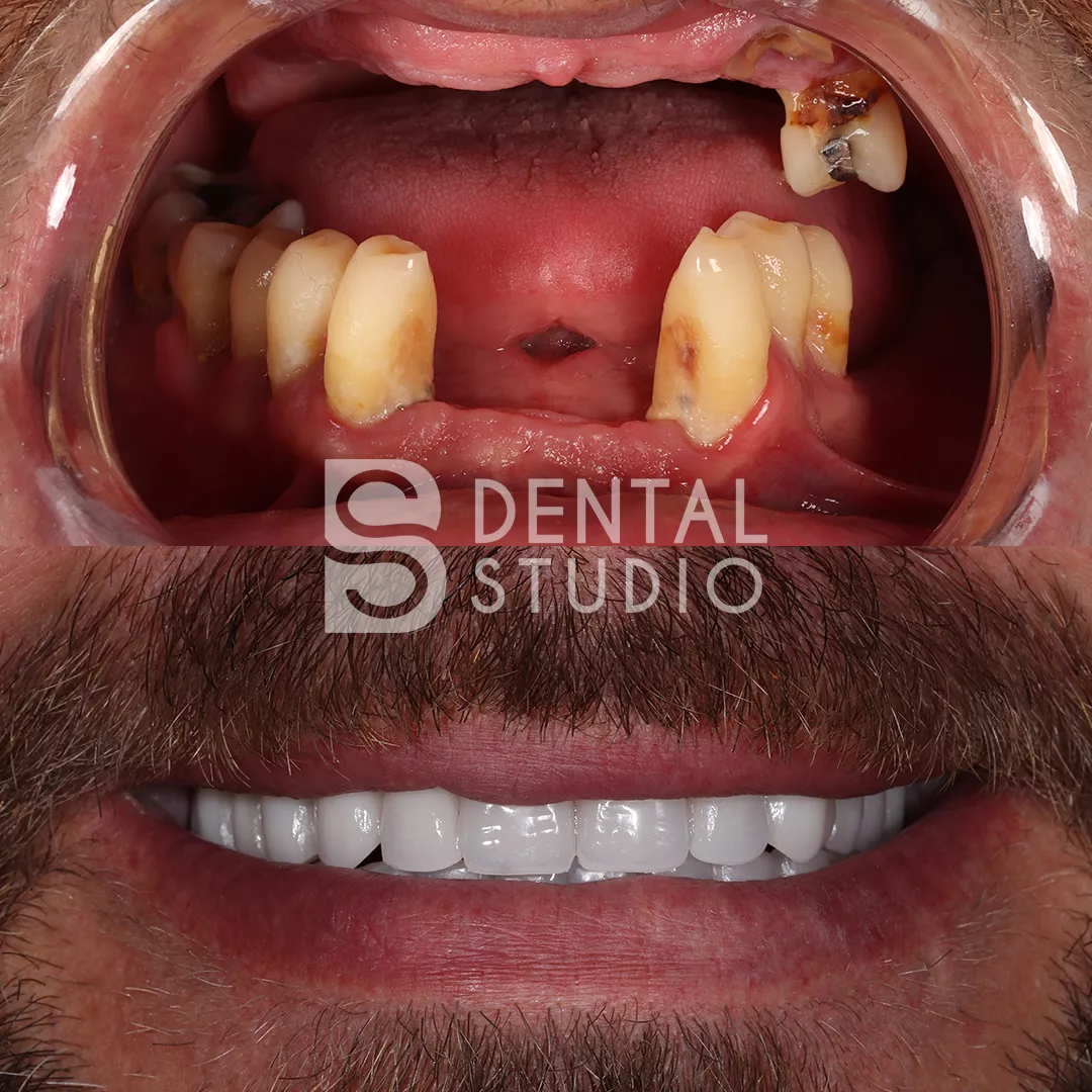 Dental Implant