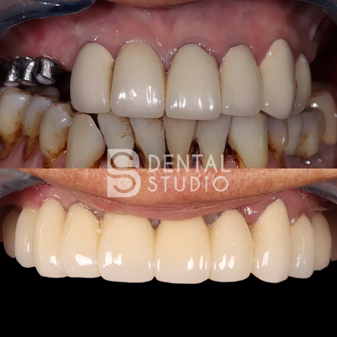 Dental Implant