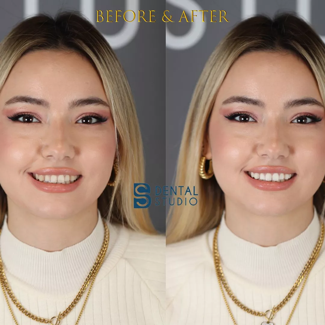 Teeth Whitening