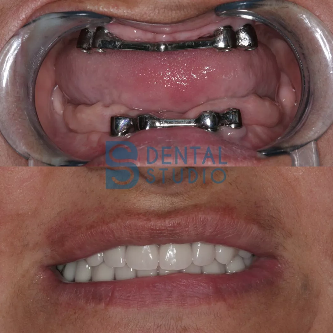 Dental Implant