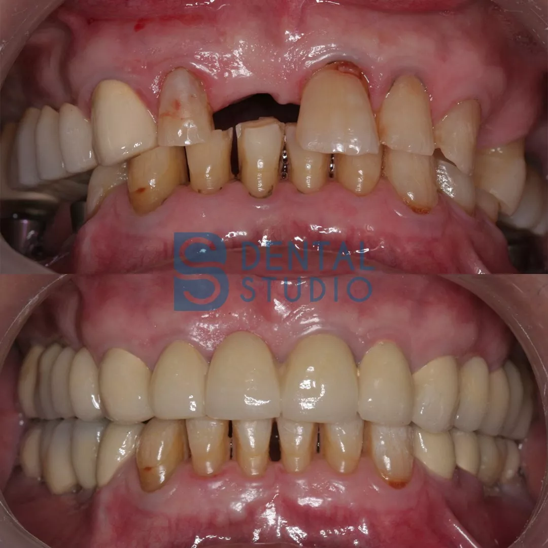 Zirconium Crowns