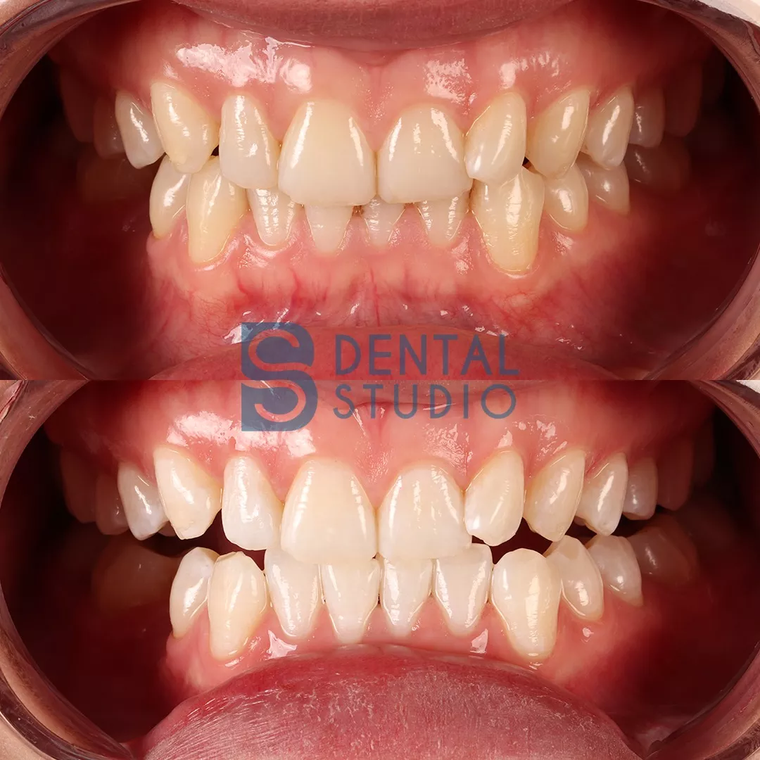 Teeth Whitening