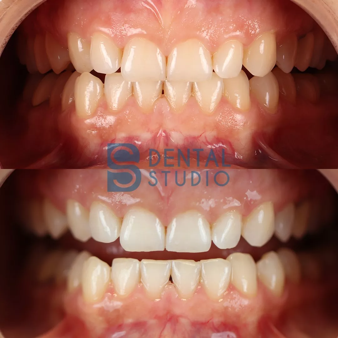 Teeth Whitening