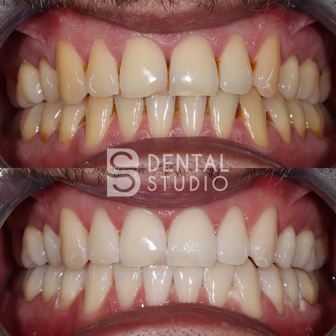 Teeth Whitening