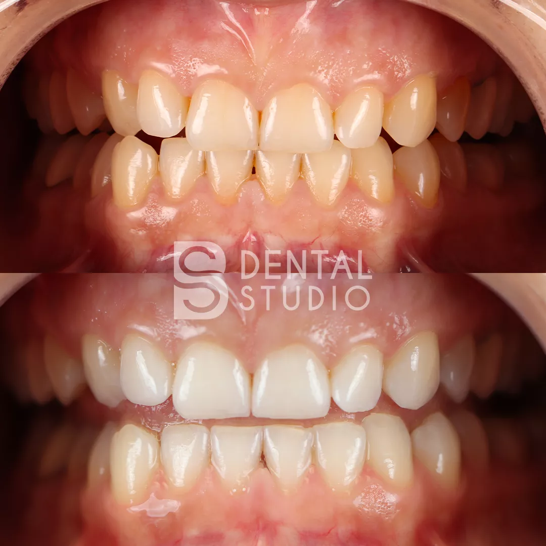 Teeth Whitening
