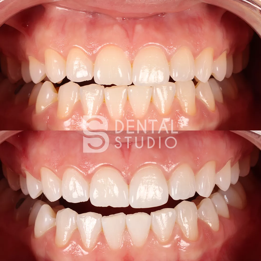 Teeth Whitening