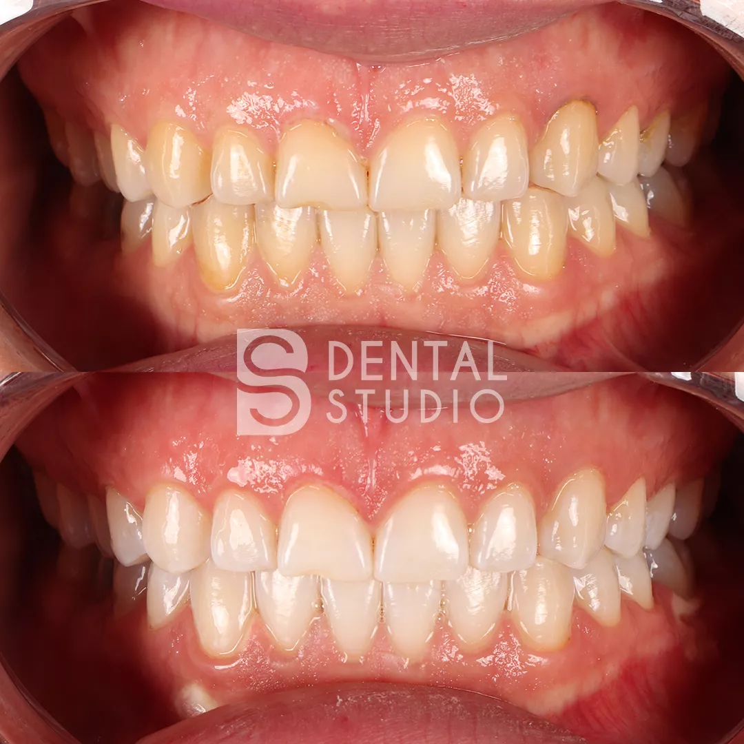 Teeth Whitening