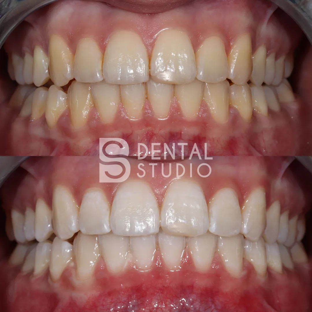 Teeth Whitening