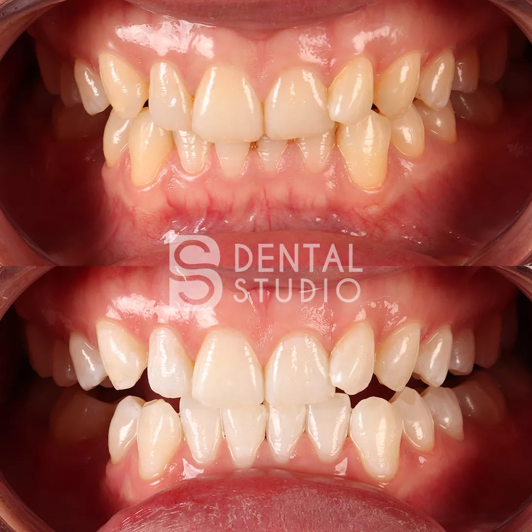 Teeth Whitening