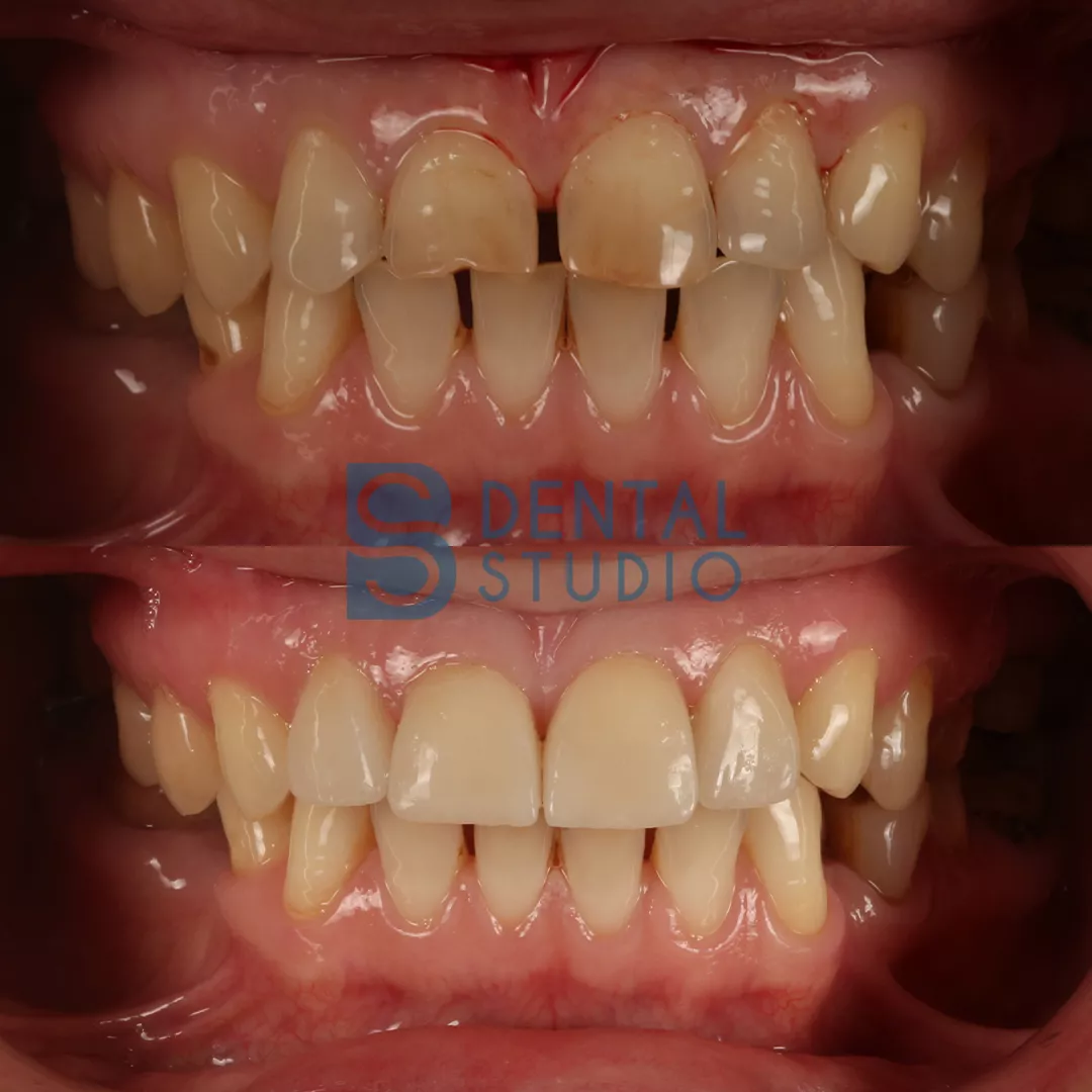 Laminate Veneers