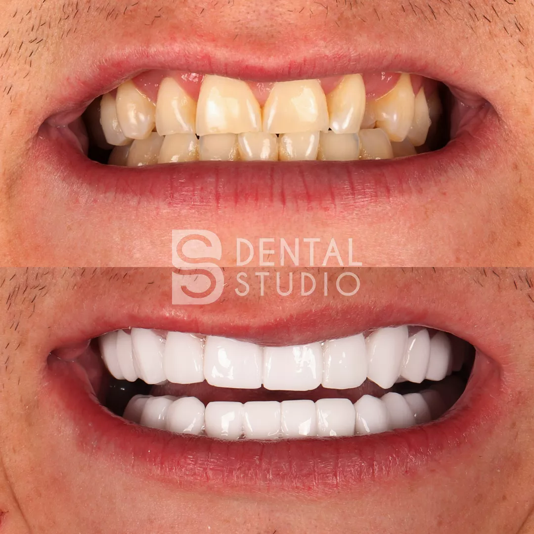 Zirconium Crowns