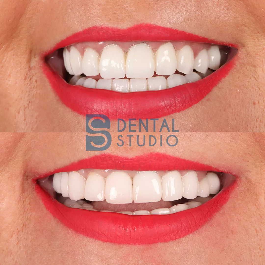 Zirconium Crowns