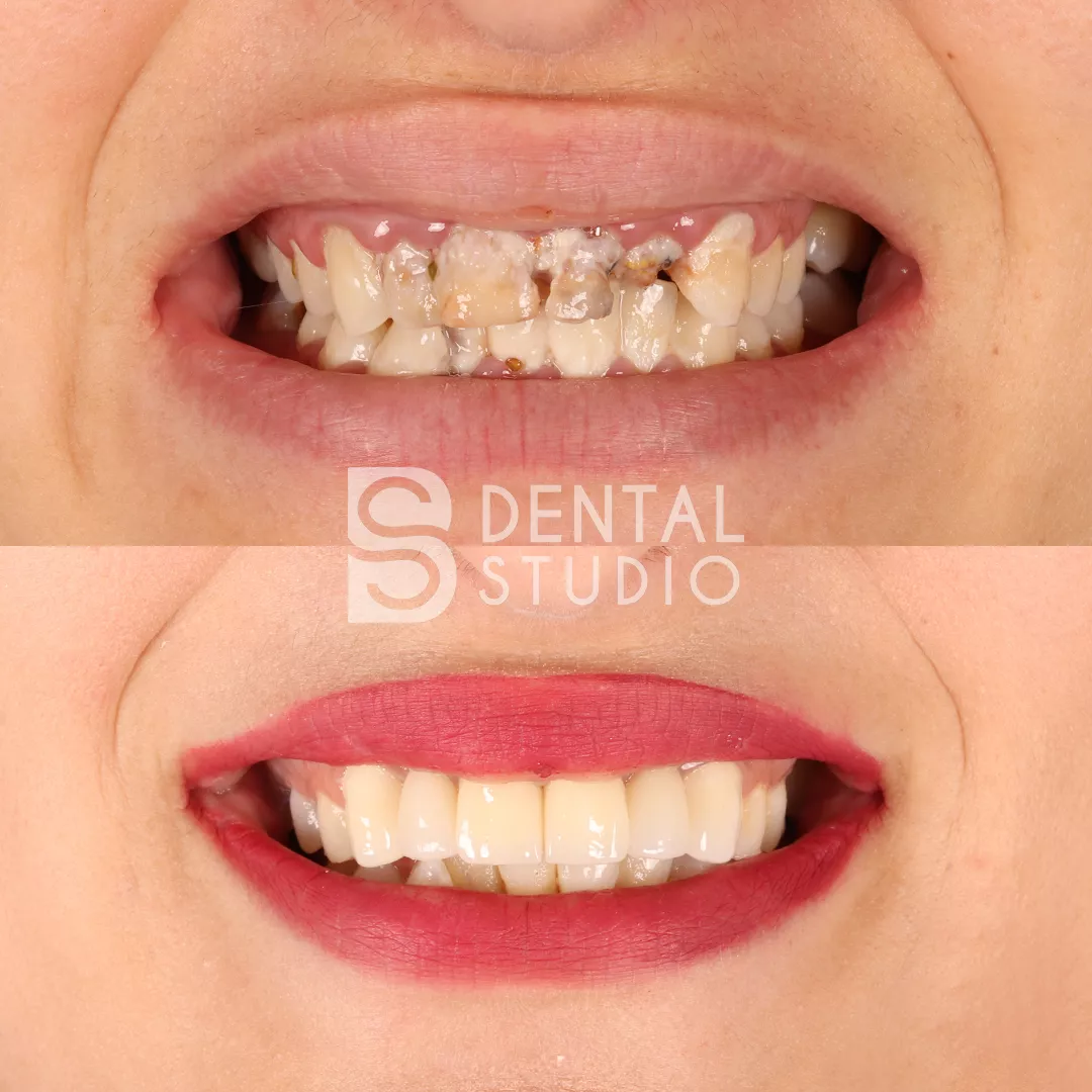 Zirconium Crowns