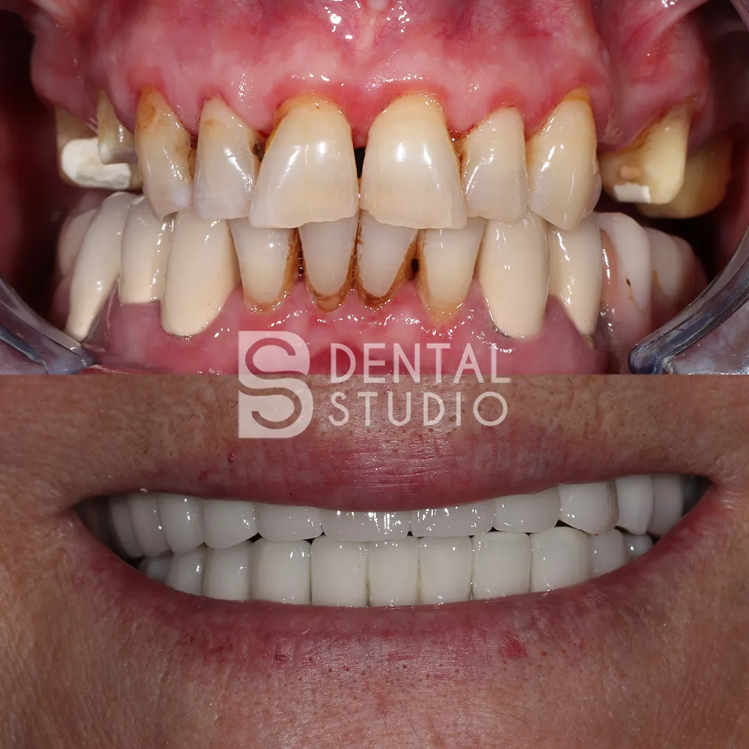 Zirconium Crowns