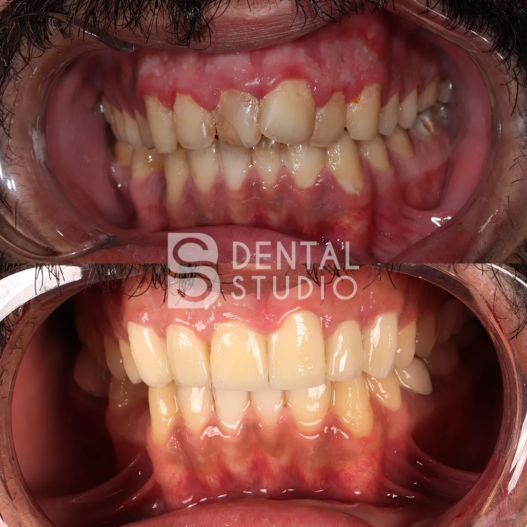 Zirconium Crowns