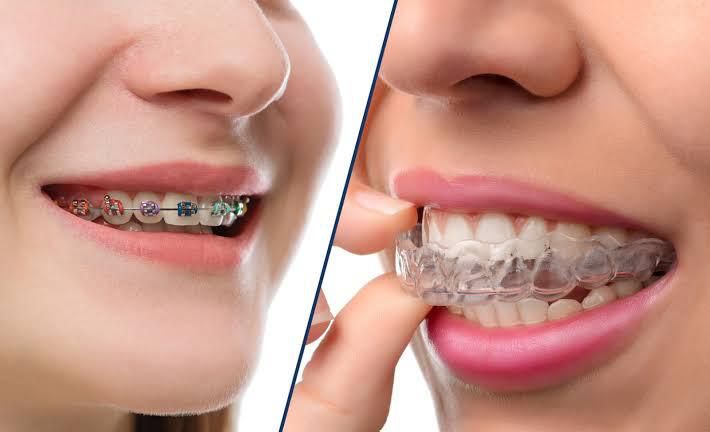 Orthodontic Treatments & Invisaling