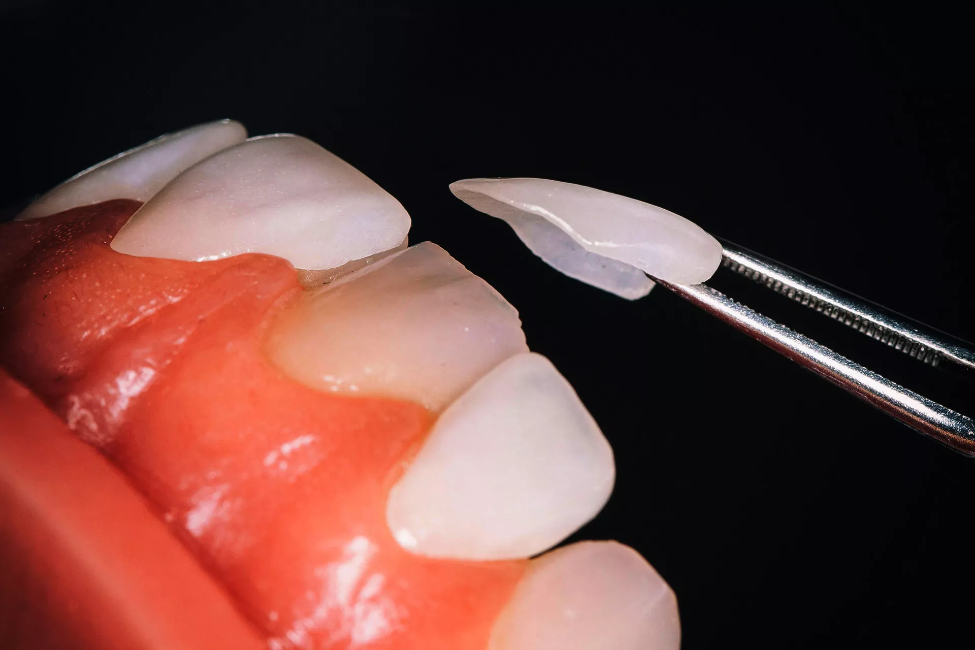 Laminate Veneers