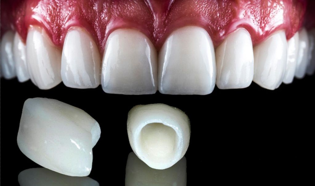 Zirconium Crowns